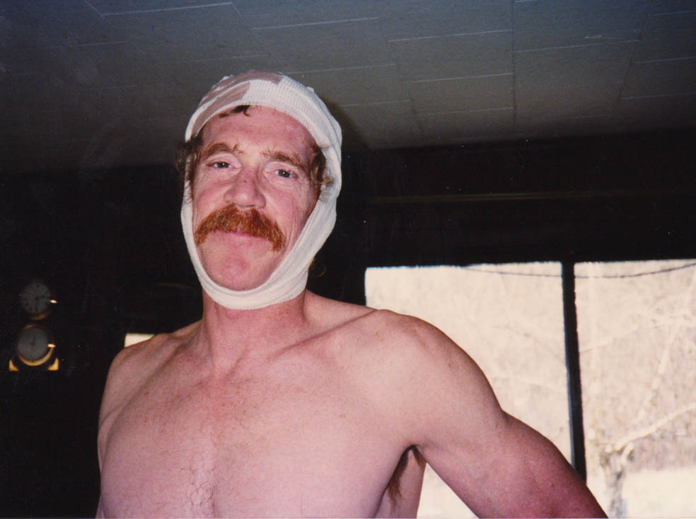 dennis basal cell removal